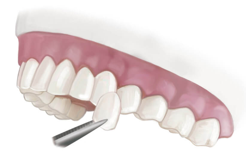 کلینیک دندانپزشکی دانا مزایا و معایب لمینیت دندان