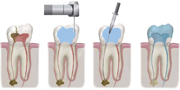 کلینیک دندانپزشکی دانا همه چیز در مورد عصب کشی بدون درد و درمان ریشه