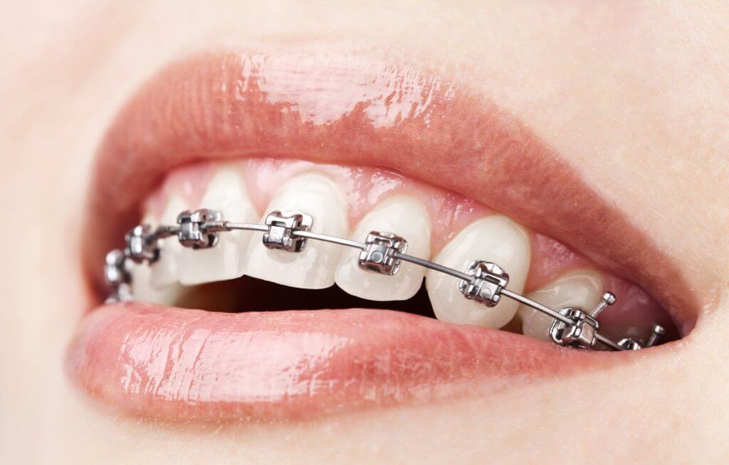 کلینیک دندانپزشکی دانا از چه سني ارتودنسي را شروع کنیم