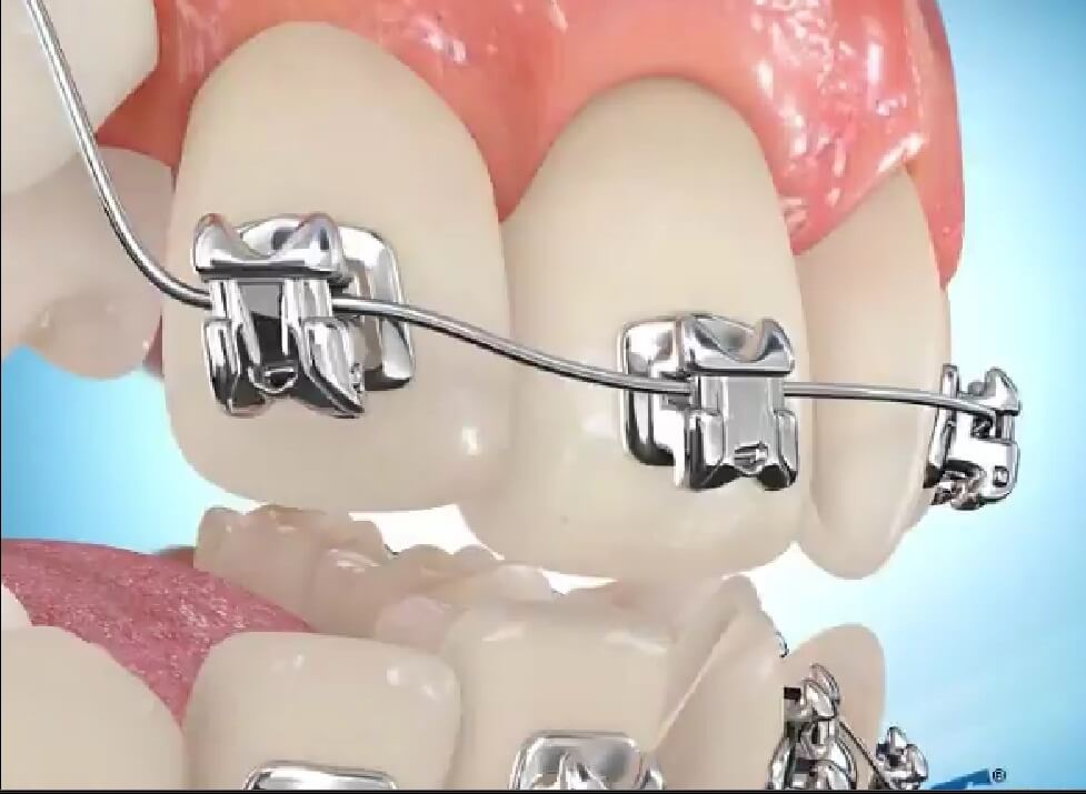کلینیک دندانپزشکی دانا سرعت درمان ارتودنسی ؟ آیا شدنی‌ست؟ ارتودنسی رشت