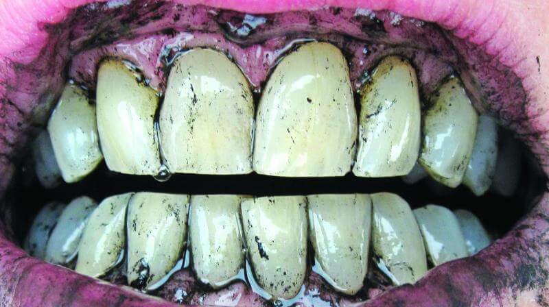 کلینیک دندانپزشکی دانا سفید کردن دندان با زغال