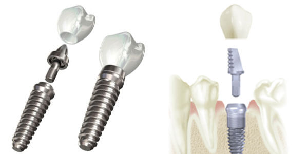 کلینیک دندانپزشکی دانا همه چیز در مورد ایمپلنت های فوری ایمپلنت چیست