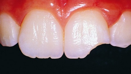 کلینیک دندانپزشکی دانا درد تاج دندان علل و راه های درمان