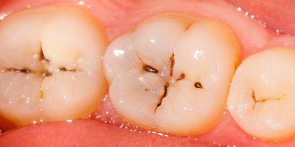 کلینیک دندانپزشکی دانا پوسیدگی مینای دندان چگونه شروع می شود و چگونه آن را متوقف کرد؟