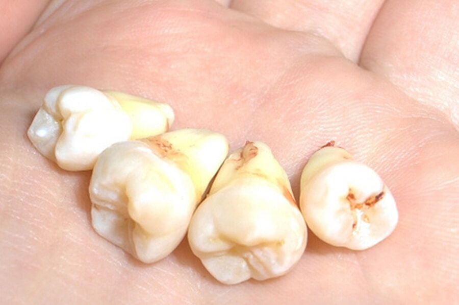 کلینیک دندانپزشکی دانا چند توصیه در خصوص دندان عقل نهفته