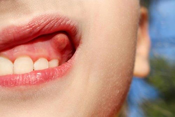 خطرات آبسه دندان