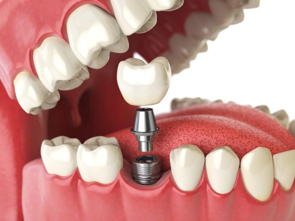 ایمپلنت دندانی