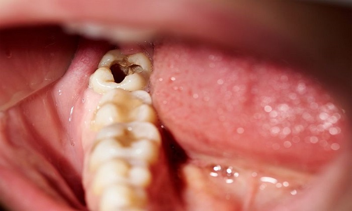 کلینیک دندانپزشکی دانا دانستنی‌هایی درباره پوسیدگی دندان