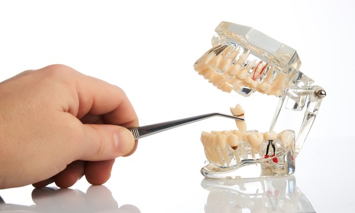 کلینیک دندانپزشکی دانا مراقبت‌های پس از کشیدن دندان