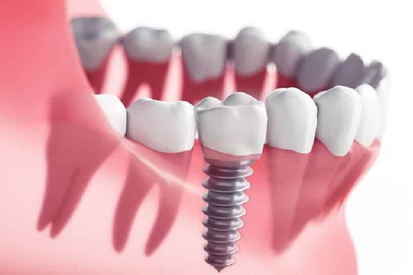 کلینیک دندانپزشکی دانا ایمپلنت چیست؟ ایمپلنت چیست