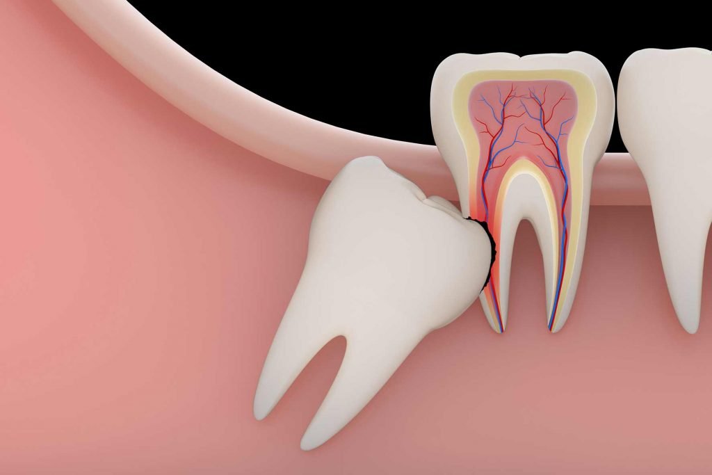 کلینیک دندانپزشکی دانا همه چیز درباره دندان عقل دندان نهفته