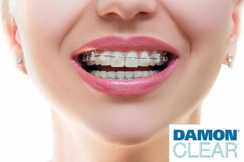 کلینیک دندانپزشکی دانا ارتودنسی دیمون چیست؟