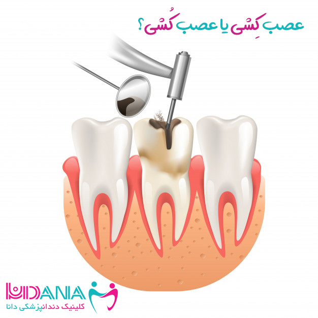 کلینیک دندانپزشکی دانا عصب کِشی یا عصب کُشی؟