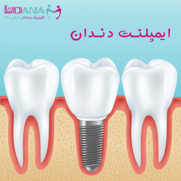 کلینیک دندانپزشکی دانا ایمپلنت دندان چیست؟