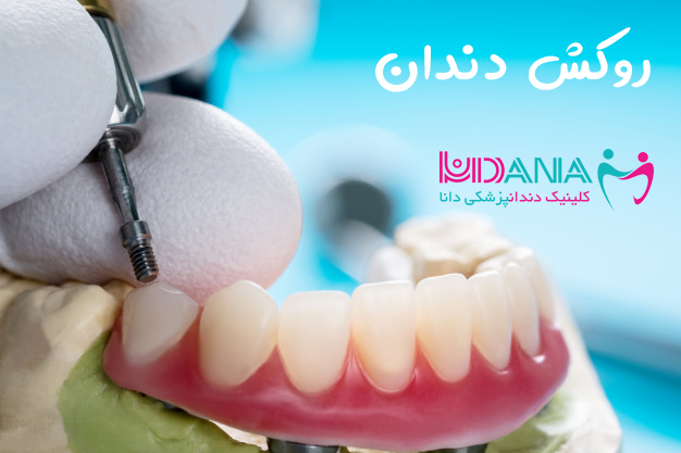 کلینیک دندانپزشکی دانا روکش دندان در گیلان پوسیدگی دندان