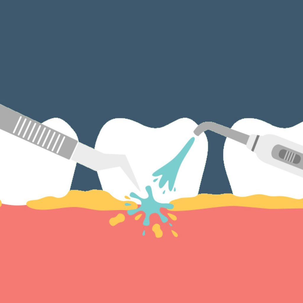 کلینیک دندانپزشکی دانا جرمگیری برای دندان مضر است!