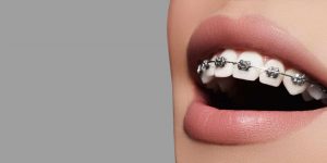 کلینیک دندانپزشکی دانا  ملاحظات و مراقبت های در طول درمان ارتودنسی ثابت ارتودنسی رشت