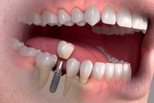 کلینیک دندانپزشکی دانا ایمپلنت فوری راهی سریع برای رسیدن به لبخندی جذاب ایمپلنت فوری